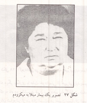 تصویر یک بیمار مبتلا به میکزودم