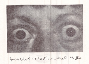 اگزوفتالمی در پرکاری تیروئید